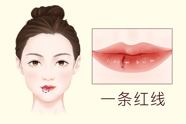 嘴唇整容費用是多少-易網健康養生網 嘴唇整容費用是多少