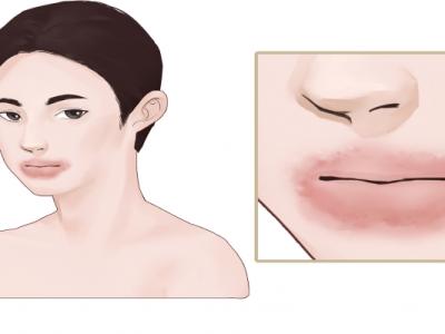 臉部過敏發紅發癢怎么辦