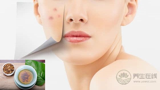 秋燥上火“痘痘”長,去痘要分虛實治 秋燥上火“痘痘”長,去痘要分虛實治