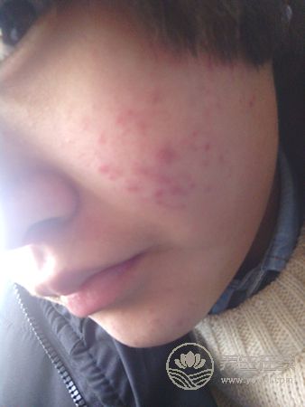 長青春痘怎么辦?不同位置有不同藥方 長青春痘怎么辦?不同位置有不同藥方