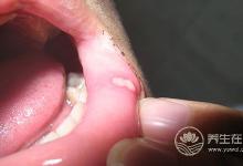 夏天口腔潰瘍怎么辦？5種水果助你排毒治病