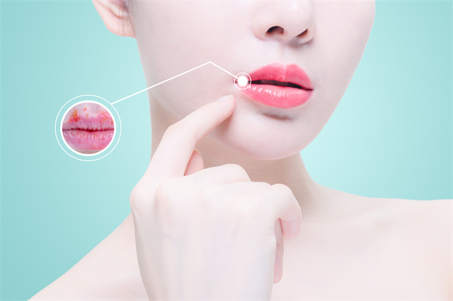 春天嘴唇經(jīng)常干裂怎么辦？這些妙招幫你緩解