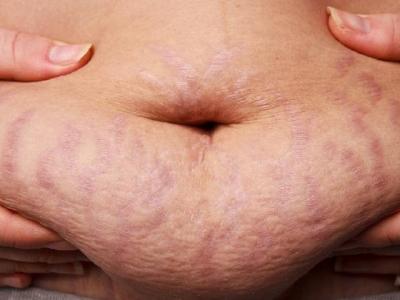 如何判斷花粉過敏癥狀 兩招判斷自己是否是花粉過敏