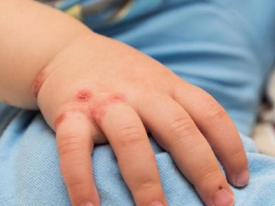 春季花粉過敏有什么方法可以防治 春季易花粉過敏中醫(yī)防治有高招