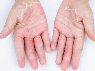 冬季手腳脫皮？找到4種原因