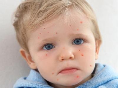 冬天穿鞋謹防濕疹 教你如何防止?jié)裾顝桶l(fā)