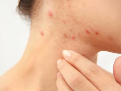 秋天女人吃什么改善皮膚過敏，秋季皮膚過敏怎么辦？