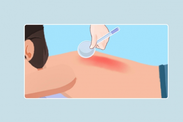 三伏天可以刮痧拔罐嗎-易網<a href=http://www.jsjjzhkt.cn/ target=_blank class=infotextkey>健康養生</a>網 三伏天可以刮痧拔罐嗎