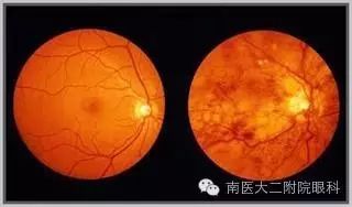 高血壓病人易出現眼底出血