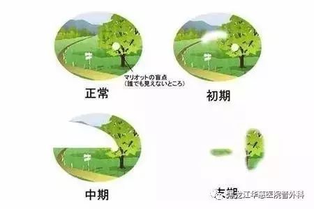 電腦族防治青光眼的小招數