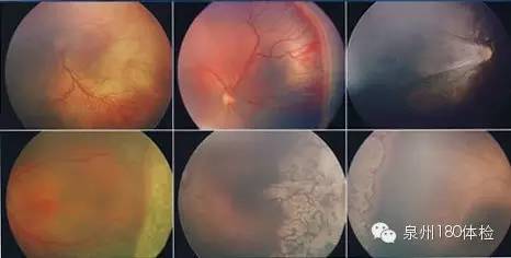 忽視糖尿病治療會致雙目失明？