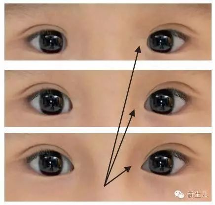 怎樣區別你的寶寶是否有斜視眼? 怎樣區別你的寶寶是否有斜視眼?