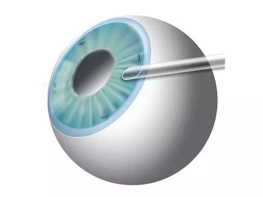 高度近視朋友需要預防六種常見并發癥 高度近視朋友需要預防六種常見并發癥