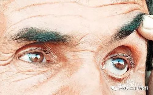 眼內進了異物應當怎么處理? 眼內進了異物應當怎么處理?