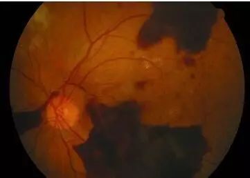 糖尿病會導致眼睛失明，視力模糊是前期征兆！