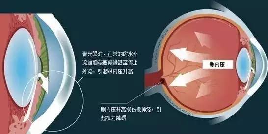 青光眼的三個危險級別,你了解嗎? 青光眼的三個危險級別,你了解嗎?
