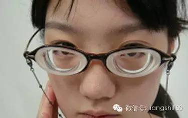 警惕,高度近視眼底病變 警惕,高度近視眼底病變