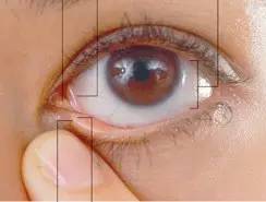 點眼藥水的正確步驟和姿勢