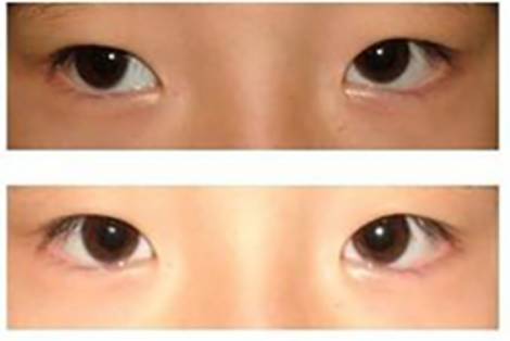 孩子眼睛模糊,就是近視? 孩子眼睛模糊,就是近視?