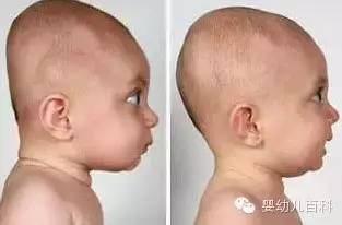 孩子的頭型與睡枕頭有關系嗎? 孩子的頭型與睡枕頭有關系嗎?