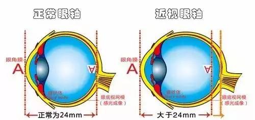 弱視是怎么形成的?它與近視有哪些區別? 弱視是怎么形成的?它與近視有哪些區別?