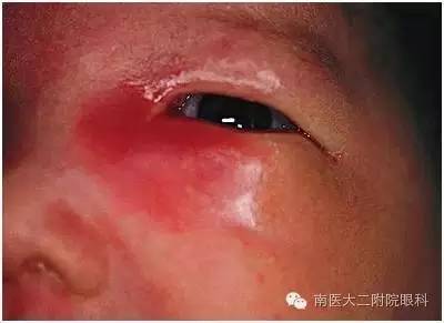 兒童兒淚囊炎的三種發病原因