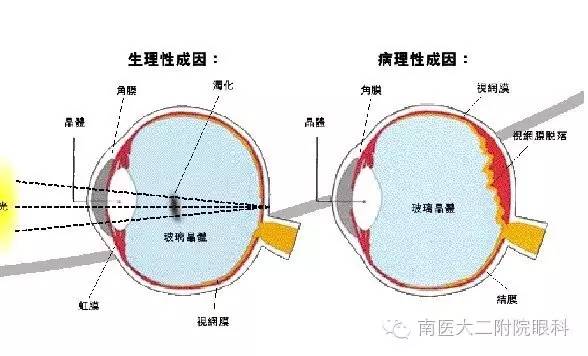 警惕，近視眼更容易得飛蚊癥