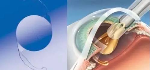 白內障患者如何選擇適合自己的手術晶體？