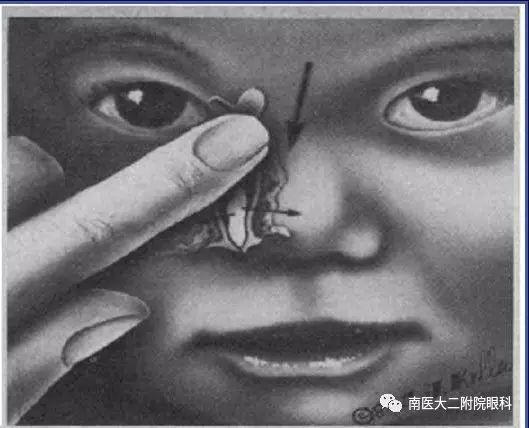 先天性淚道阻塞如何進行按摩? 先天性淚道阻塞如何進行按摩?