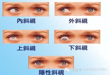 小兒斜視什么時候做最好? 小兒斜視什么時候做最好?