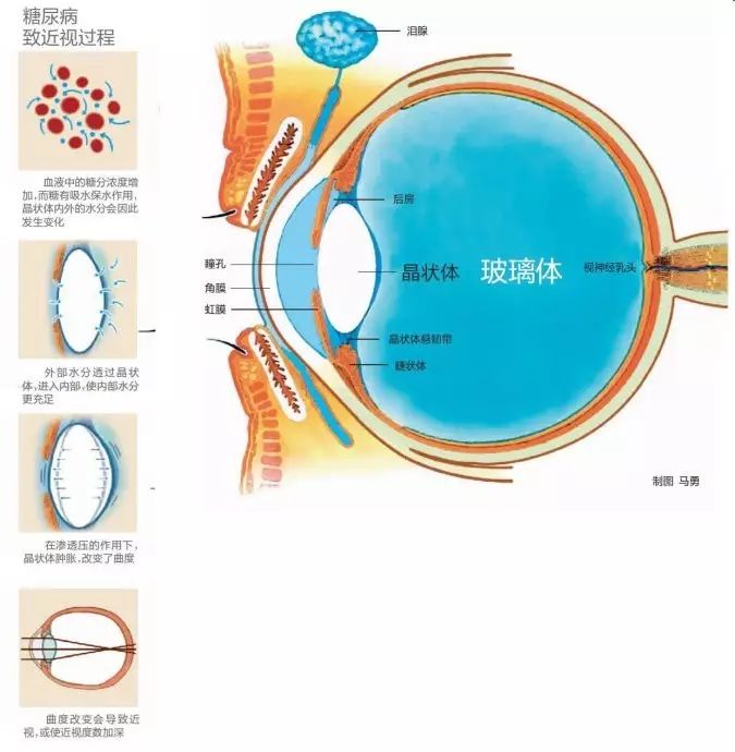 糖尿病會導致眼睛失明，視力模糊是前期征兆！