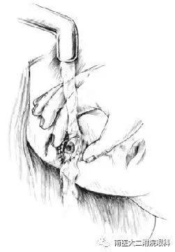 眼內進了異物應當怎么處理? 眼內進了異物應當怎么處理?