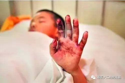 重視兒童眼外傷