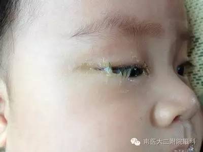 兒童兒淚囊炎的三種發病原因