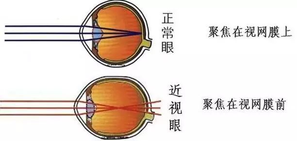 瞇眼睛真的能看的更清楚嗎? 瞇眼睛真的能看的更清楚嗎?