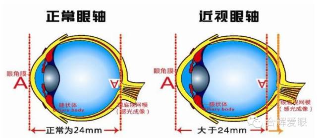 眼鏡戴久了,眼睛會(huì)變形嗎? 眼鏡戴久了,眼睛會(huì)變形嗎?