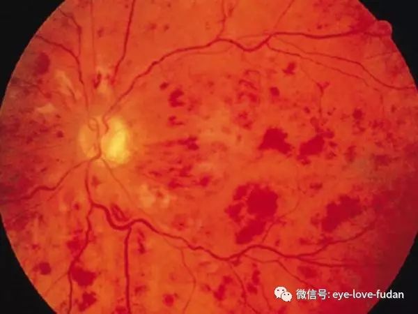 糖尿病眼底病變的病人,請注意! 糖尿病眼底病變的病人,請注意!