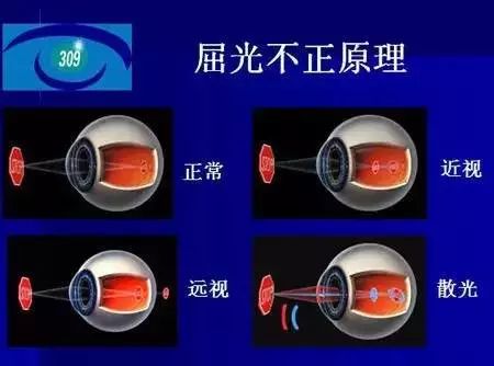 弱視是怎么形成的?它與近視有哪些區別? 弱視是怎么形成的?它與近視有哪些區別?