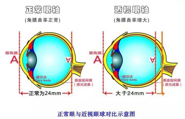 孩子近視度數猛漲？近視防控小心誤區！