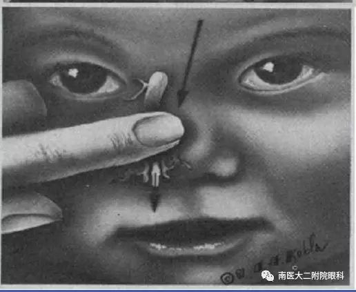 先天性淚道阻塞如何進行按摩? 先天性淚道阻塞如何進行按摩?