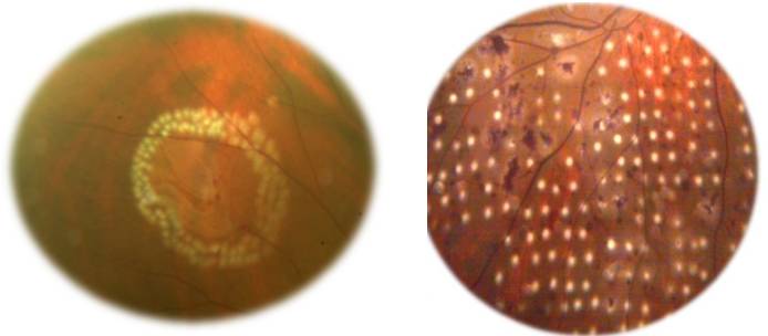 眼底打激光是怎么回事? 眼底打激光是怎么回事?