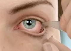 點眼藥水的正確步驟和姿勢