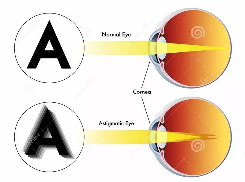 關(guān)于散光,這些你都了解嗎? 關(guān)于散光,這些你都了解嗎?