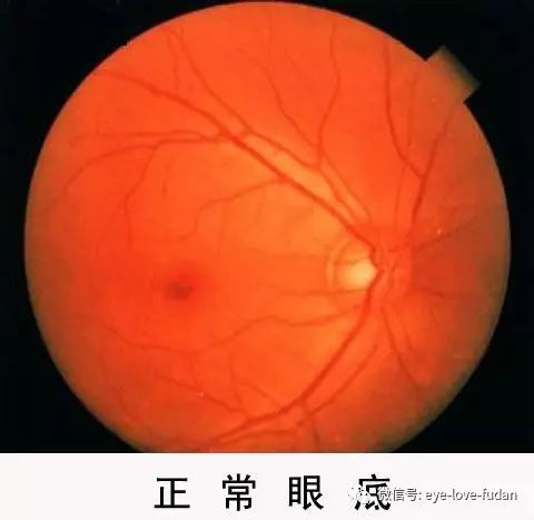 糖尿病眼底病變的病人,請注意! 糖尿病眼底病變的病人,請注意!