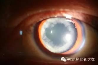 逃不開的眼疾病——白內(nèi)障