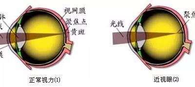 詳解近視、散光、遠視、斜視及弱視
