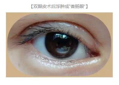 雙眼皮術后出現上瞼下垂怎么辦？