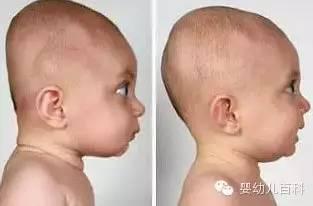 孩子的頭型與睡枕頭有關系嗎？