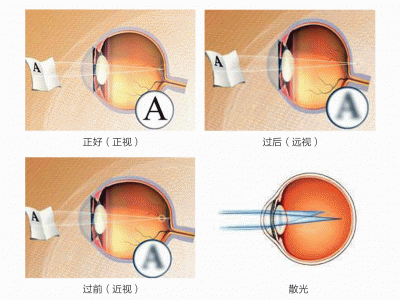 屈光不正是什么意思？