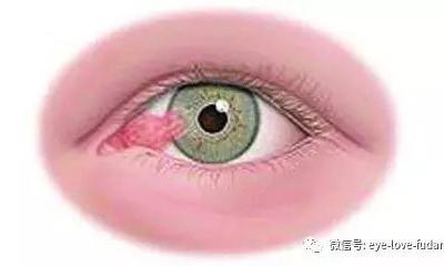 人眼為什么會(huì)長“多肉”？